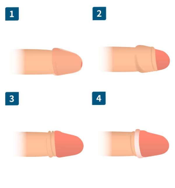 ABC Clinic ABC式CSカット レビュー