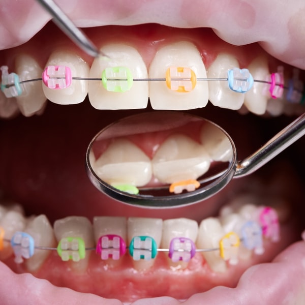 Correct My Tongue Thrust Review