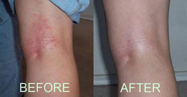 Eczema Free You Review