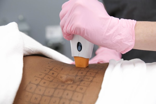 LaserAway CoolSculpting Non-surgical Fat Reduction Review