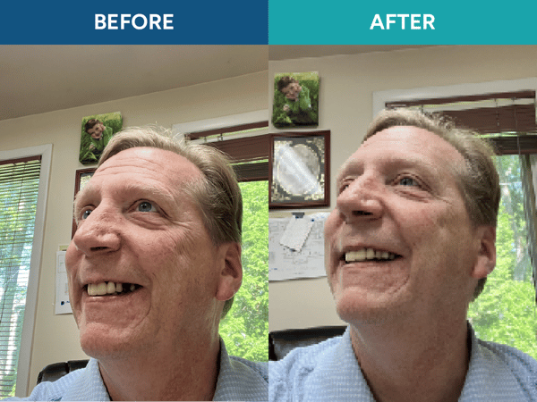 About ResetSmile
